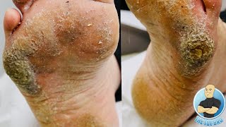EXTRA THICK HARD SKIN REMOVAL TREATMENT ***CRAZY BIG CALLUS***