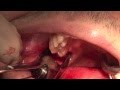 Wisdom Tooth Extraction : GRAPHIC CONTENT Story ...