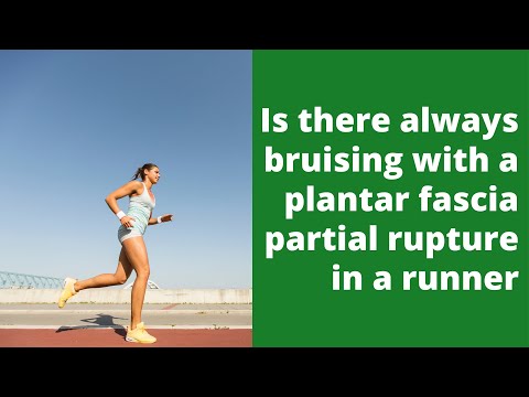 Is there always bruising with a plantar fascia partial rupture in a runner
