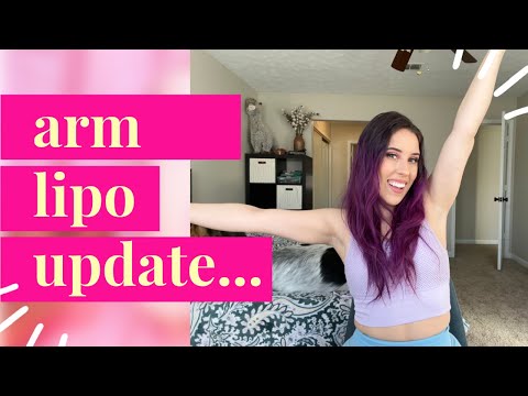 ARM LIPO UPDATE! | 9 months post-op