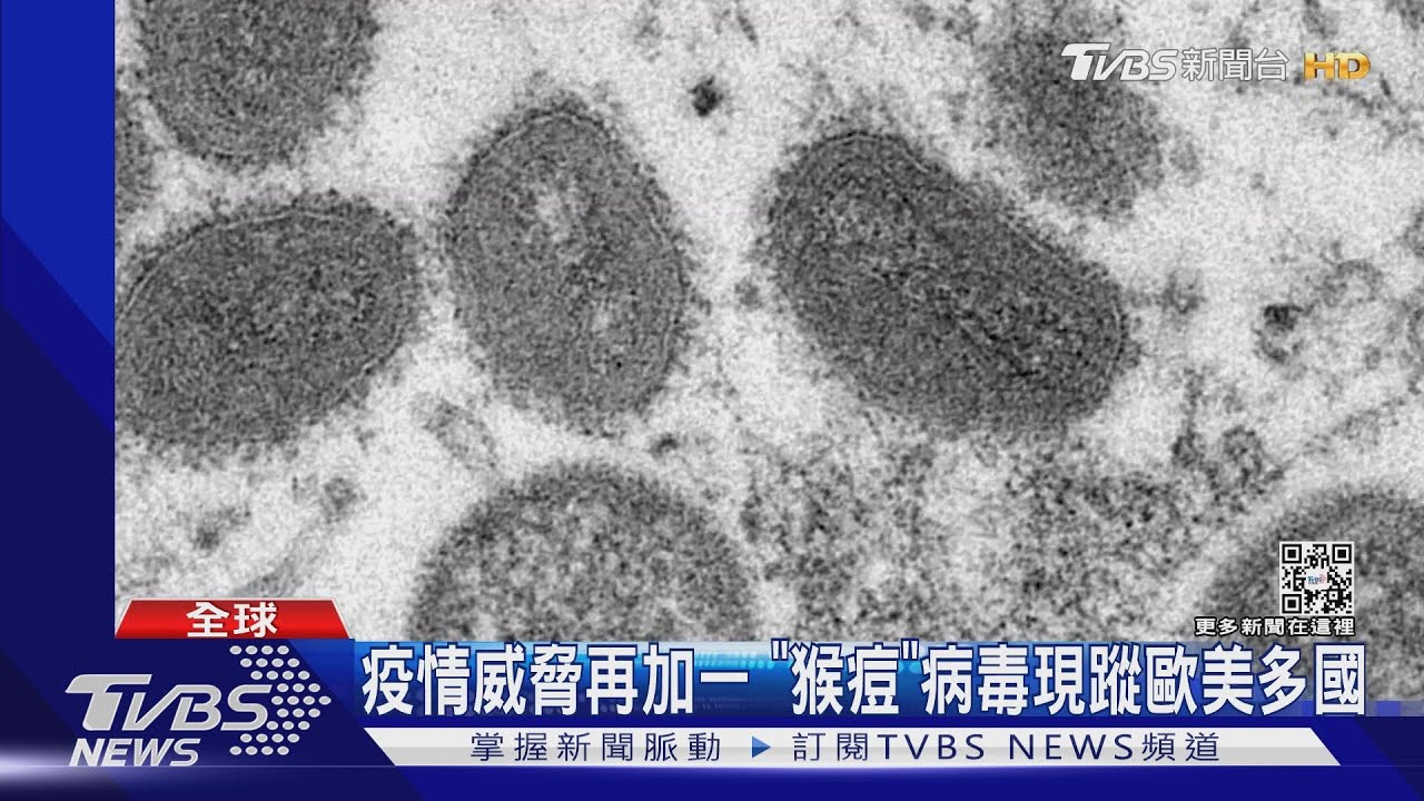 疫情威脅再加一 「猴痘」病毒現蹤歐美多國
