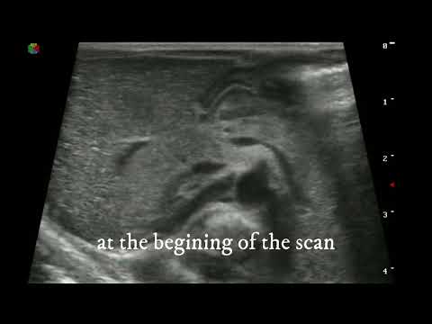 Radiology quiz (4) :: pediatric abdominal ultrasound :: Dr.Mohamed Soliman