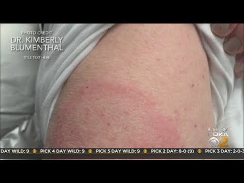 'COVID Arm' Pfizer And Moderna Vaccine Side Effects