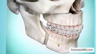preview picture of video 'Treatments for Sleep Apnea - Dr. Schendel - Palo Alto, CA'