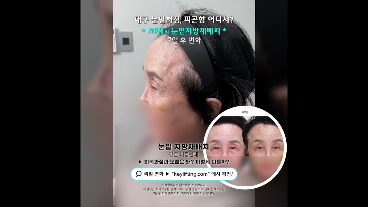 70대의 눈밑지방재배치 7일후 모습