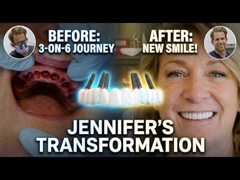 3 on 6 Dental Implants: A Real Patient’s Experience with More Natural Dental Implants #3on6