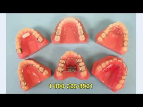 Habit Appliances | Dental Habit Appliances | Habit Appliance Labs