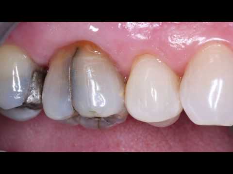 V1904 Reliable, Simple Treatment of Cracked Teeth