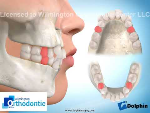 Four-bicuspid Extraction all 2nd