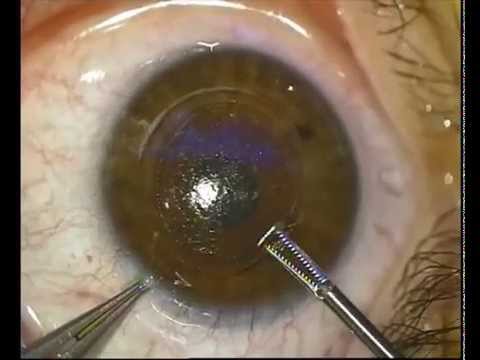 Disc pentru restaurarea vederii binoculare
