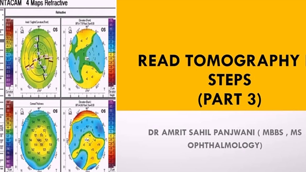 How to read corneal tomography printout || Pentacam