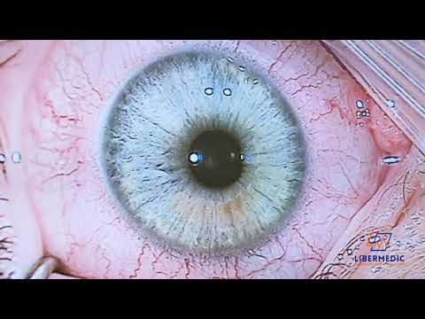 Laserowa korekcja wady wzroku (LKW) - SmartSurf - dr Łukasz Kołodziejski