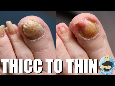 CRAZY THICK NAIL TRANSFORMATION!!! ***BEFORE & AFTER*** Video