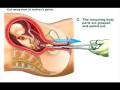 Abortion Illustrated / 23 Weeks Gestational Age ...