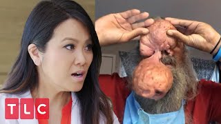 Man Has Enormous Nodules On His Nose! | Dr. Pimple Popper: Before the Pop