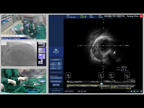 Complex PCI to LAD and Diagonal Bifurcation Guided by IVUS