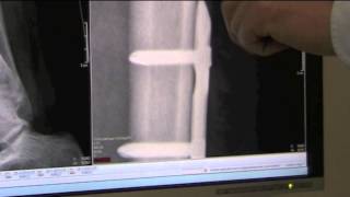 preview picture of video 'Broken Leg Check Up - 7 Weeks after Operation X-Ray - Surgery Explained'