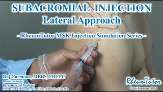 SUBACROMIAL SHOULDER INJECTION - LATERAL APPROACH: Step-By-Step Instructions