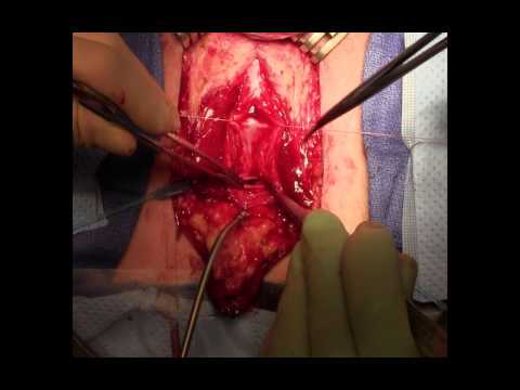 Perineal Urethrostomy