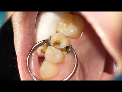 Restoration Of Tooth With Broken Wall | Proximal Caries Restoration | Class II Cavity