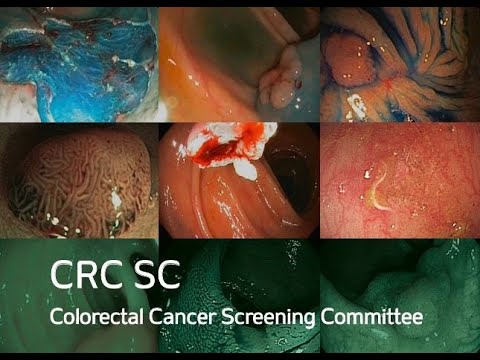 WEO CRC SC Meeting at the Asia Pacific Digestive Week (APDW) 2022