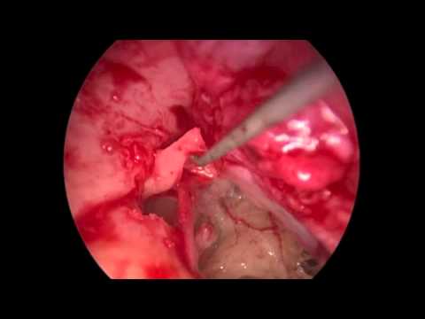 Transcanal endoscopic-assisted ossiculoplasty with transposition of the incus
