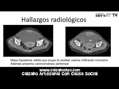 ¿Que son los sarcomas uterinos? Cancer en el utero y sus síntomas