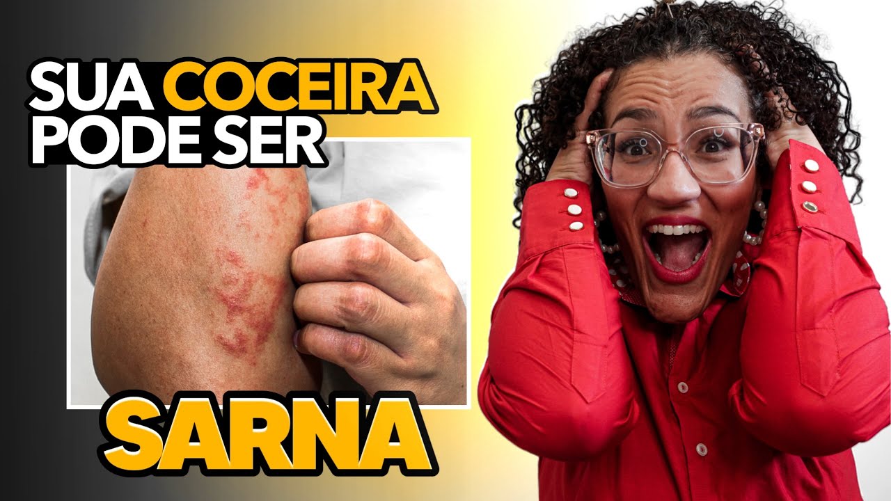 Sarna Humana ou Escabiose - Sintomas e Tratamento