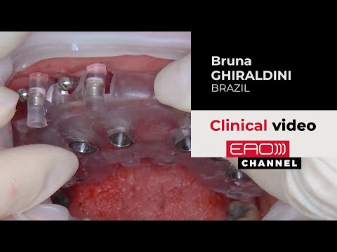 Fully Digital Workflow: Restoring the patient's smile