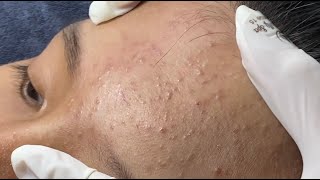 Teenager Acne Treatment P.1 #HoangMySpa192