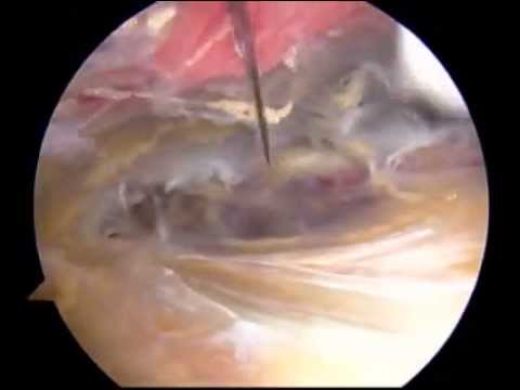 Artroskopowa tenodeza mięśnia dwugłowego ramienia