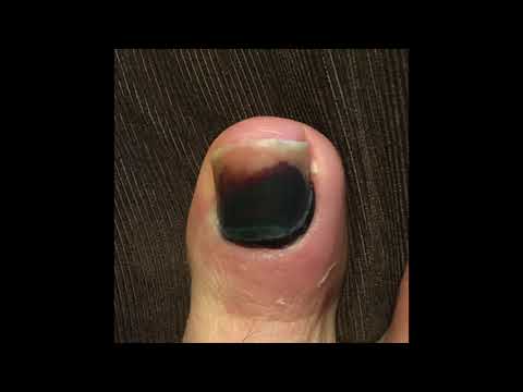 Pinakamahusay na lunas para sa kuko halamang-singaw Pundya fungus ointment