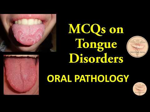 MCQs in Oral Pathology - Tongue Disorders