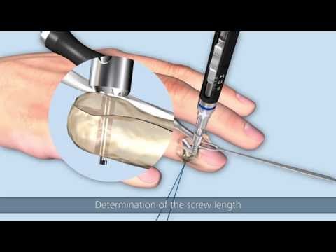 Linos – Bony extensor tendon avulsion of the distal phalanx