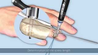 Linos | Bony extensor tendon avulsion of the distal phalanx