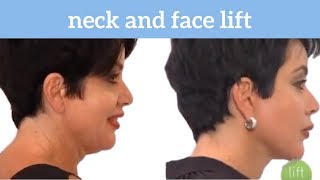 Mother of Five Gets a Facelift & Neck Lift at 49 | Nina’s Story