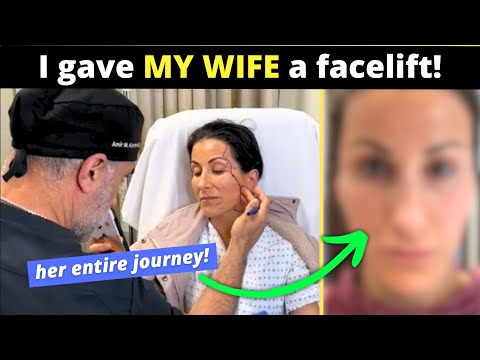 Plastic surgeon gives his wife a facelift!