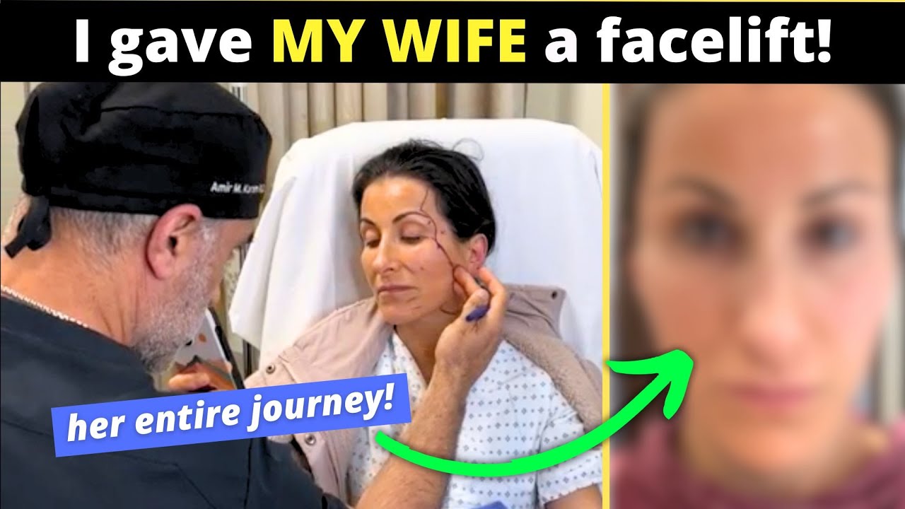 Plastic surgeon gives his wife a facelift!