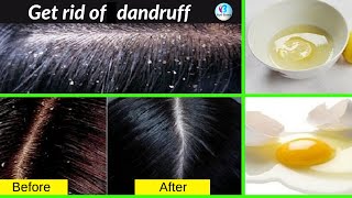 how to Get rid of dandruff and itchy scalp with homemade oil