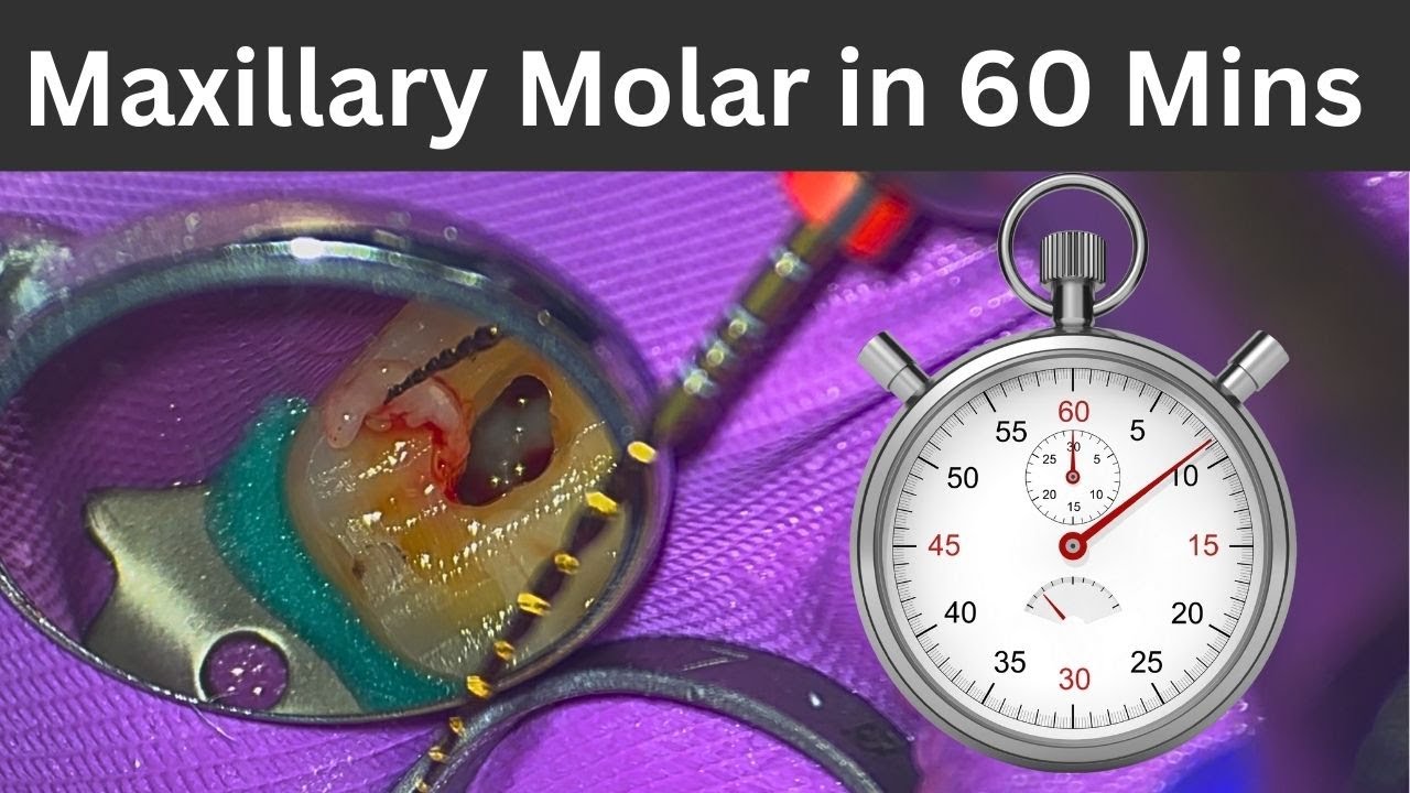 Maxillary Molar Endodontics in 1 Hour | 3 Top Efficiency Tips for Faster Root Canals