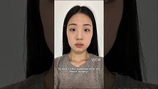Download lagu Korean Plastic Surgery Review:  Rhinoplasty, Facial Contouring, Double Eyelid Surgery #nosejobs mp3