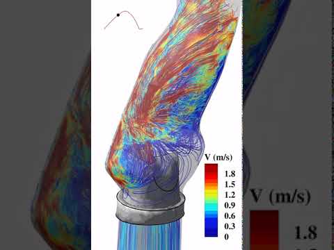 BAV vs TAV Streamlines