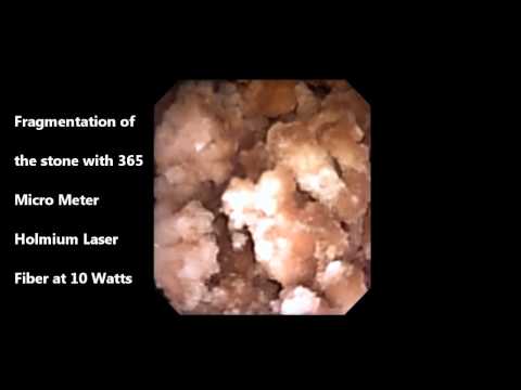 RIRS with Digital ( Chip on the Tip ) Flexible Ureteroscope by Dr  Pawan Gupta