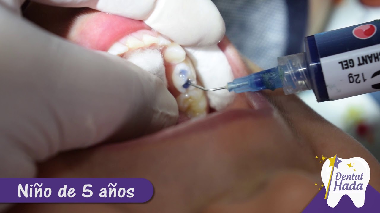 Watch Curaciones dentales en dientes de leche Now Curaciones dentales en dientes de leche