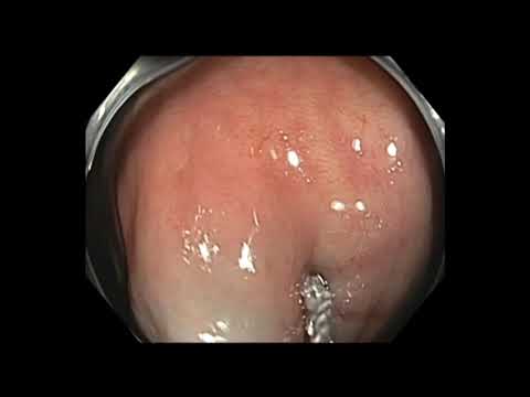 Colonoscopy: Hepatic flexure EMR - Released the Snare and Used a Small Snare