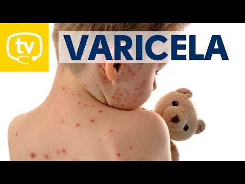 Varicela ¡todo lo que debes saber!