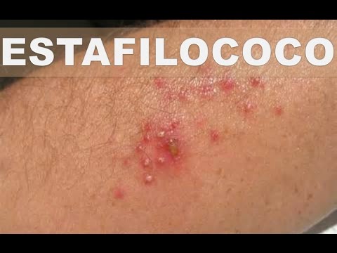 Lista non di unguenti ormonali da eczema Leczema su trattamento passa rimedi di gente