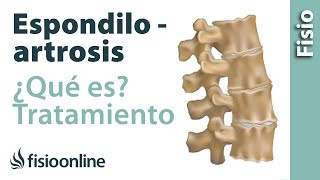 ¿Qué es la espondiloartrosis y cuál es su tratamiento