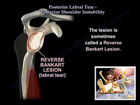 Posterior Labral Tear Shoulder Instability - Everything You Need To Know - Dr. Nabil Ebraheim