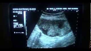 preview picture of video 'COMPLEX ( cystic and solid mass ) RT PELVIC REGION'